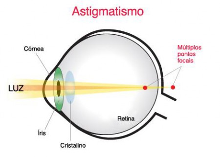 ASTIGMATISMO